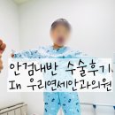 우리들의원 | 안검내반 우리연세안과의원 수술 후기