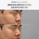 뉴원성형외과의원 | 남성분들 집중 ❣ 포항눈코성형 후의 리얼 후기