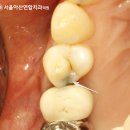 아산중앙연합의원 | 서울아산연합 치과 앞니 심미보철의 중요성 : 신경치료부터 임플란트까지 총과정