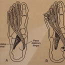 Forefoot Varus Deformity 이미지