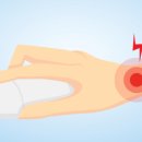 김정민한의원 | 손목터널증후군(수근관증후군) 증상과 치료의 핵심