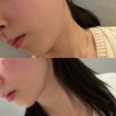 사리역 2번출구 | 성수동피부과 성수역 2번출구 30대 여자 온다리프팅 후기