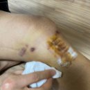 위플러스메디칼 | 전방십자인대 수술 후기 5편 | 전방십자인대 수술 후 소독 방법 &amp; 준비물 총정리 (내돈내산)