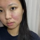 (주)메디바이오템 | [페이스팩토리] 큐어토리 72샷 메디팩 바이오셀룰로오스 | 찐 트러블 피부가 써본 후기!