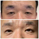 [후기] 부모님 눈쳐짐 수술 해드리기!! (눈썹거상 상안검 보톡스)