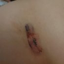 동탄행정사 | DFSP(융기성피부섬유육종) 진단 및 투병기1