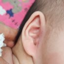 (주)메드앤텍 | [내돈내산] 다산 아이앤힐 성형외과 – 스킨텍 실밥 제거 완료! 수술 2주 차 리얼 회복기~!!