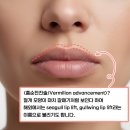 닥터탁성형외과의원 | 입술 확대 수술 3개월차 후기 (+입술 확대 수술 2가지 방법의 차이)