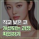 코원성형외과의원 | 코끝 연골묶기 전후 변화로 보는 자연스러운 코 라인 개선 과정
