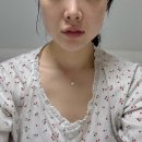 영영성형외과 | 온다+티타늄리프팅 / 쥬베룩 볼륨(팔자,마리오네트 4cc후기)💵💸💶💵