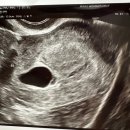 르봄여성의원 | [임신 그리고] 계류유산 판정까지(+미래여성병원 설명 방식이 맞지 않았던 진료 후기)