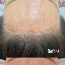 수헤어라인 이미지