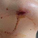 S0148 | 턱찢어짐 성형외과수술 근봉합 창상봉합술 질병코드 상해보험 상해수술비 피부 봉합 턱봉합수술 피부찢어짐