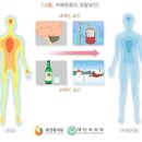 저체온증[hypothermia] 이미지