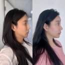 범계역 피부과의원, 울쎄라 리프팅 받아본 후기 (안양 실리프팅)