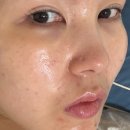 녹스 | 신사역피부과 리쥬란 에어녹스 통증 걱정 덜었던 내돈내산 후기