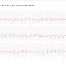 시술 2달후 재발 했습니다 이미지