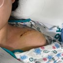 정병원 | [쇄골골절 수술 후기] 핀삽입 및 핀제거 회복 기간 2