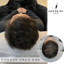 마음에점을찍다두피SMP 이미지