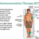 한때 너무나 해보고싶었던 전기충격요법 (ECT), 겨울입문에서 다시 생각나다 이미지