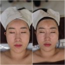오산피부관리 3V윤곽테라피 아네스뷰티 비포애프터 후기