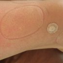 효원마취통증의학과의원 | 40대 중반, 퇴행성관절염이 왔다_효원통증의학과