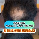 [부산 탈모 디자인 시술 후기] 펌과 SMP로 변화한 12명 탈모 Before &amp; After 결과는?