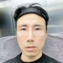 땅콩약국 | 땅콩형 얼굴 주름 실리프팅후 통증 및 붓기 효과 후기