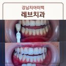 신사역치과 '레브치과의원' 내돈내산 원데이 치아미백