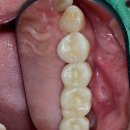 평촌이생각치과의원 | 평촌치과추천, 임플란트 시기 놓쳤다면 '이것'부터 보세요 [필독]