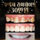 강동스카이(Sky)치과기공소 | 상일동역 라미네이트, 왜 누군가는 부작용을 겪고, 누군가는 10년 넘게 멀쩡할까?