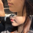 행복한유앤갑외과의원 | [공지] 강남윤곽주사 이중턱지방흡입 (소개팅주사), 인모드FX후기 통증 멍