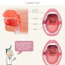 편도 절제술 받고 회복 중!!! 편도선 수술 앞둔 여시 머리채를 잡는당(징그러운 사진1장 주의) 이미지