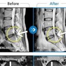 방사통 뜻 원인 하지 허벅지 통증 다리 팔 저림 디스크 심근경색 치료 이미지