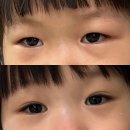 갈매기어린이집 | 아기 쌍꺼풀 생기는 시기, 가능성 / 세돌까지의 외모변화