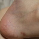 케이앤제이씨 | 찰과상은 물론 벌레물림까지 커버되는 케이앤제이씨 케타바실 사용 후기 :)