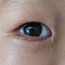 햇빛어린이집 | 31개월 아기 하안검내반 수술 전후 비교 + 1주일 후기!