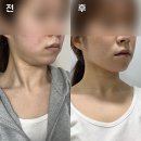 신에너지 | 대전 땅꽁형얼굴 맞춤리프팅 :: 올타이트 리프팅 • 페이스하프컷 / 내돈내산 솔직후기