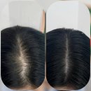 차없는거리 문화로 채우다(1차) | 강남 헤어라인 두피문신 잘하는곳 추천ㅣ강남 smp 여자 가르마채움 블랙카운티 3회차 솔직후기