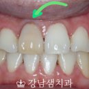 서울미소샘치과의원 네이버블로그