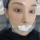 비올라셀성형외과의원 | 신사역 비올라셀성형외과 입술필러 일주일차 솔직 후기