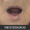 이엘치과의원 | 이천임플란트, 틀니 사용에 지친 50대 환자 후기