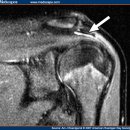 견봉하활낭염(肩峰下滑囊炎, Subacromial Bursitis) - 물리추나치료 이미지