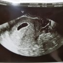 안녕하세요 네이버 주수로 임신 7주 6일차 예비맘입니다. 초음파 사진좀 봐주세요. 이미지