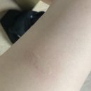 고데기 화상으로 수술한 입원 일기(푸른병원/심재성 2도화상/화상치료/대구화상치료/화상치료보험/화상...