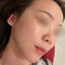 (주)가교 | 선릉역 피부과 내돈내산 워터밤주사 후기