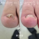 패디히얼 | 마곡동네일샵 패디히얼 마곡점 내성발톱 무좀발톱 발각질 가격 비용