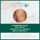 케이씨에스부산수흉부외과의원 | 하지정맥류 치료의 표준 방법, 고주파(RFA)치료