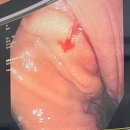 WR(인천광역시 서구)-[길주로]-하-41 | [일상블로그]생애 첫 대장내시경을 해보다 두둥 (feat. 국가건강검진/위내시경/복부초음파)