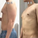 남성여유증 정보 속 진실은? 궁금증 해결 비법 [Dr.디에이 여유증]